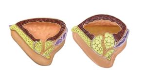 GPI Anatomicals® Male Pelvis With BPH Model