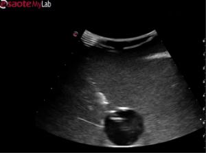 Abscess drainage µltrasound training model