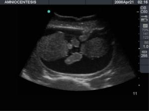 Amniocentesis µltrasound training model