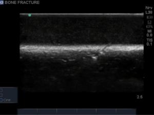 Bone fracture µltrasound training block model with greenstick fractures