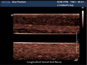 Regional anesthesia µltrasound training block model