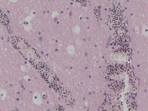 Plasmodium falciparum, Brain, Hematoxylin & Eosin Stained Section Slides