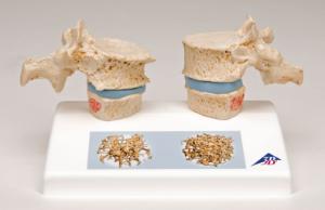 3B Scientific® Osteoporosis Model