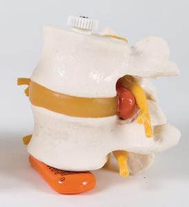 3B Scientific® 2 Lumbar Vertebra With Prolapsed Disc