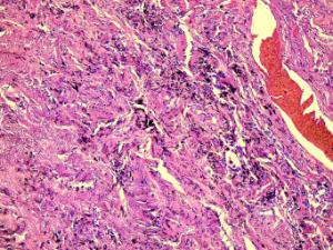 Lung, Tuberculosis (Human) Slide