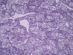 Kidney Carcinoma Slide