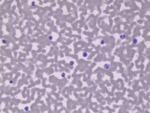 Polycythemia Slide