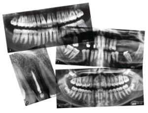 Roylco Dental X-Rays