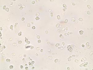 Urine Sediment, Unstained Slide