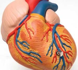 3B Scientific® Heart With Left Ventricular Hypertrophy (LVH)