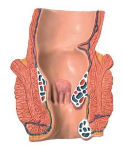 3B Scientific® Hemorrhoid Model