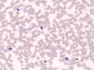 Eosinophilia Slide