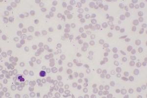 Sickle Cell Anemia