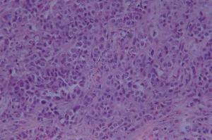 Lung Carcinoma Slide