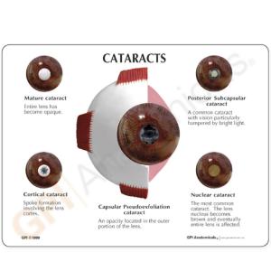 GPI Anatomicals® Cataract Eye Model