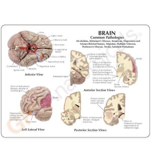 GPI Anatomicals® Brain in Skull Pathologies Model