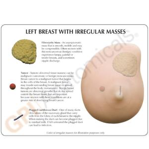 GPI Anatomicals® Left Breast With Irregular Masses Model