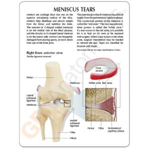 GPI Anatomicals® Meniscus Knee Model