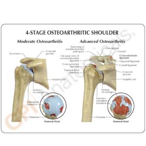 GPI Anatomicals® Osteoarthritis Stages Model