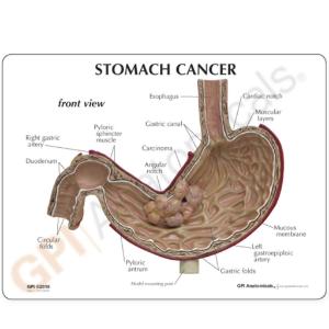 GPI Anatomicals® Stomach Cancer Model