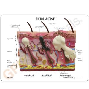 GPI Anatomicals® Skin Normal/Acne Model