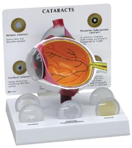 GPI Anatomicals® Cataract Eye Model