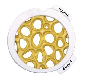 GPI Anatomicals® 4-Stage Osteoporosis Disk Set