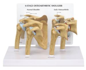 GPI Anatomicals® Osteoarthritis Stages Model