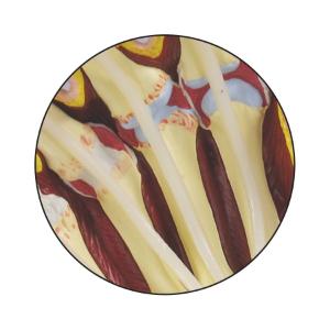 GPI Anatomicals® Rhumatoid Arthritis Hand Model