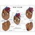 GPI Anatomicals® Heart Disease Model Set