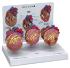 GPI Anatomicals® Heart Disease Model Set